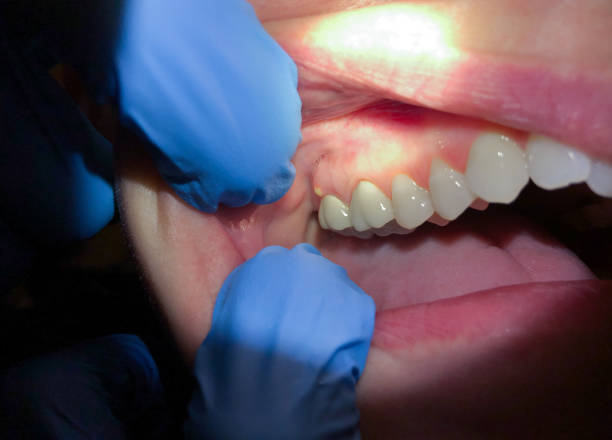 Best Emergency Gum Pain Relief  in Feather Sound, FL